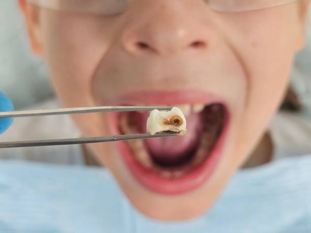 Best Emergency Tooth Extraction in Brewster, OH
